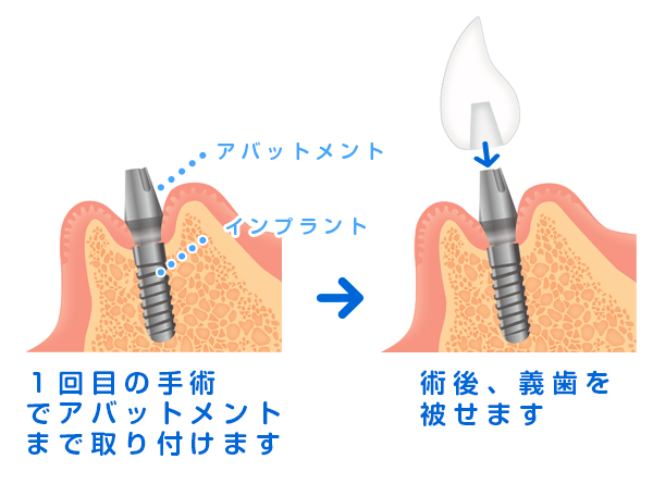 榊原デンタルクリニックインプラント１回法