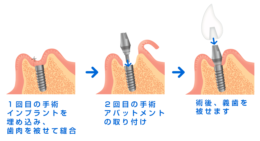 榊原デンタルクリニックインプラント２回法