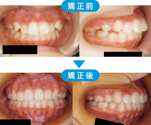 矯正治療