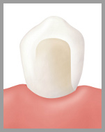 オールセラミッククラウン