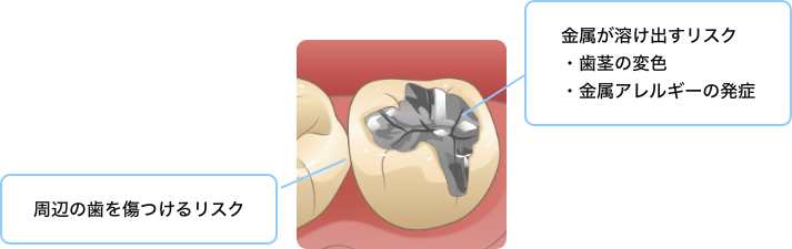 金属を口腔内から外した方が良い理由